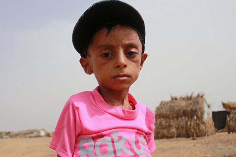 Yemeni boy fights malnutrition as hunger stalks nation’s children