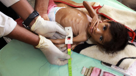 UN: 100,000 Yemeni Children in Danger of Starvation